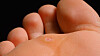 fjern vorte på finger fjern vorte på finger